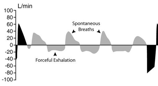 APRV:  Overdistension